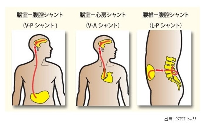 第5回 特発性 とくはつせい 正常圧水頭症 Inph をご存じですか 治る可能性のある認知症 かしわばブログ 柏葉脳神経外科病院